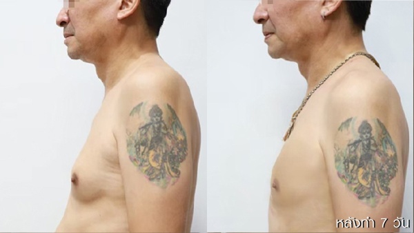 ลดขนาดหน้าอกผู้ชาย