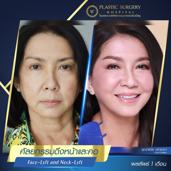 ดึงหน้า