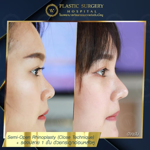 เสริมจมูก