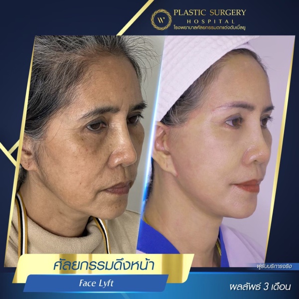 ดึงหน้า