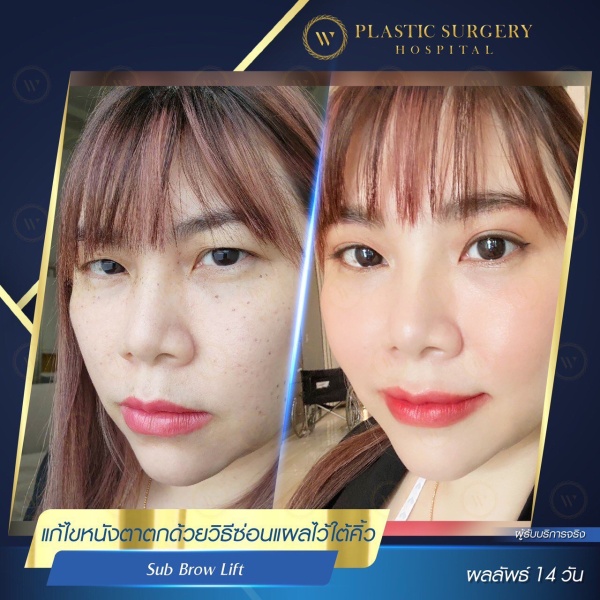 หนังตา/หางตาบนตก