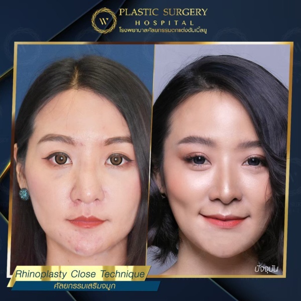 เสริมจมูก