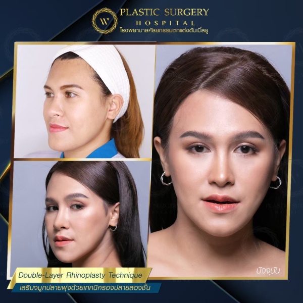 เสริมจมูก