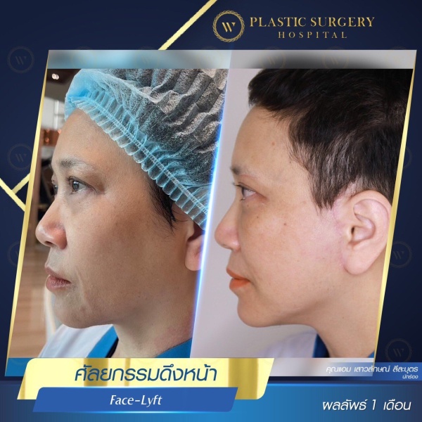 ดึงหน้า