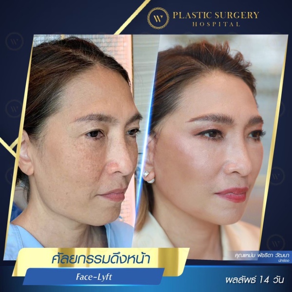 ดึงหน้า