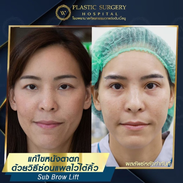 หนังตา/หางตาบนตก