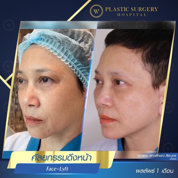 ดึงหน้า