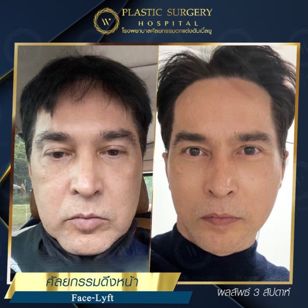 ดึงหน้า