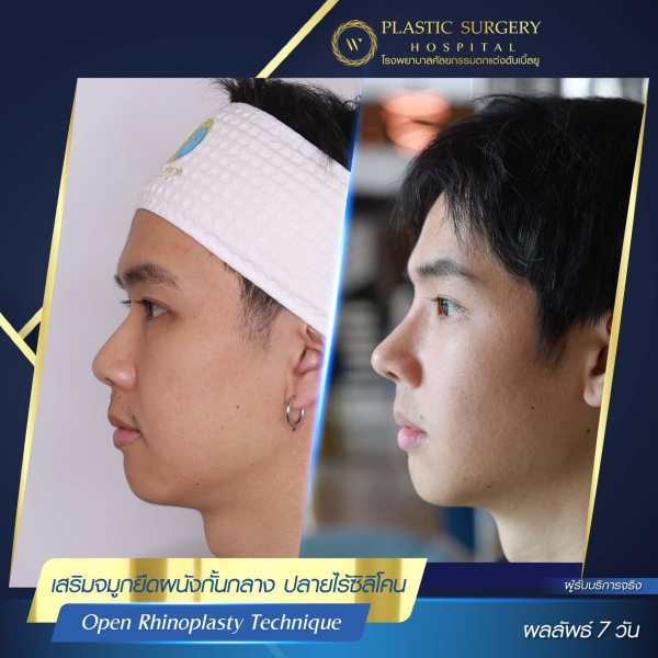 เสริมจมูก