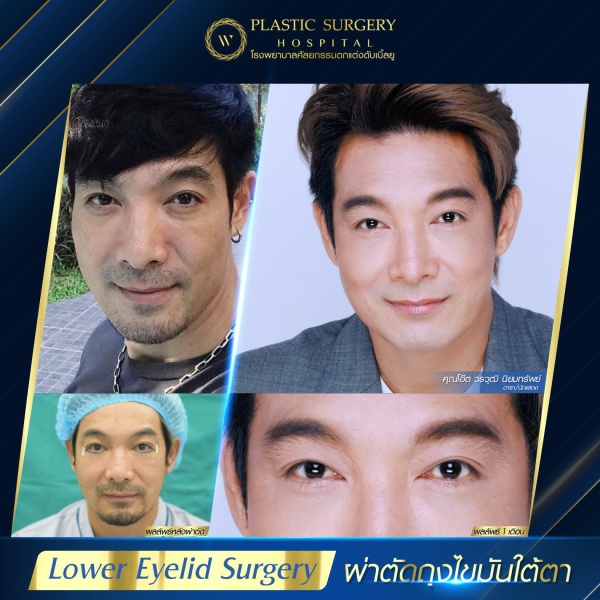 Lower Eyelid Surgery