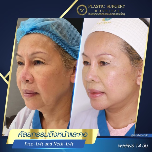 ดึงหน้า