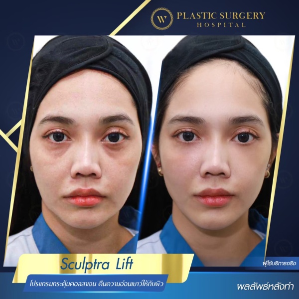 Sculptra Lift