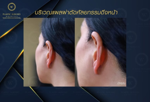 ดึงหน้า