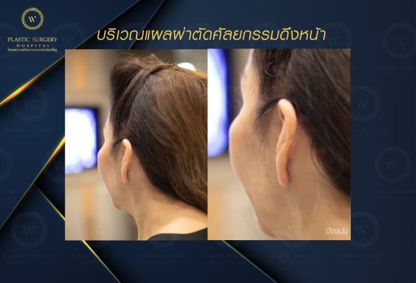 ดึงหน้า