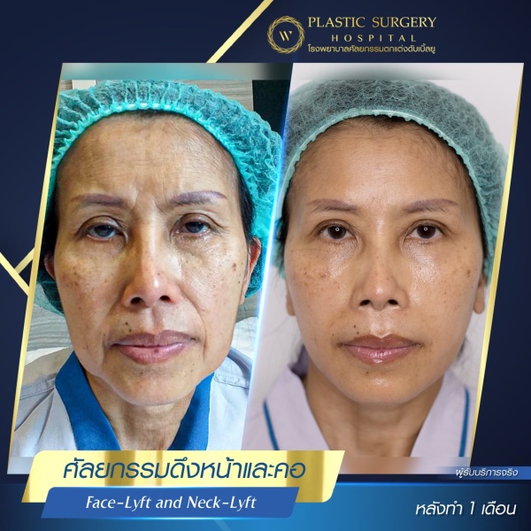 ดึงหน้า