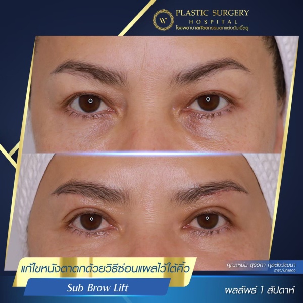 หนังตา/หางตาบนตก