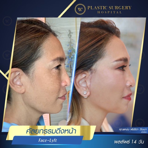 ดึงหน้า