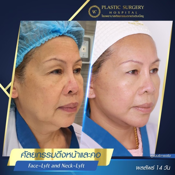 ดึงหน้า