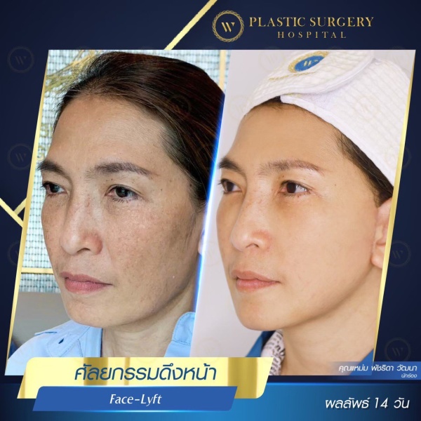 ดึงหน้า