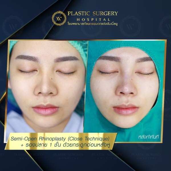 เสริมจมูก