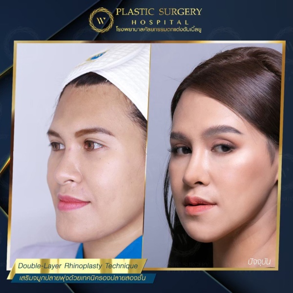 เสริมจมูก