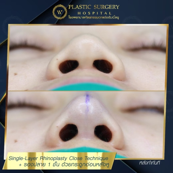 เสริมจมูก