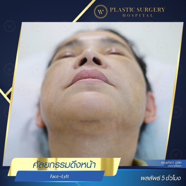 ดึงหน้า