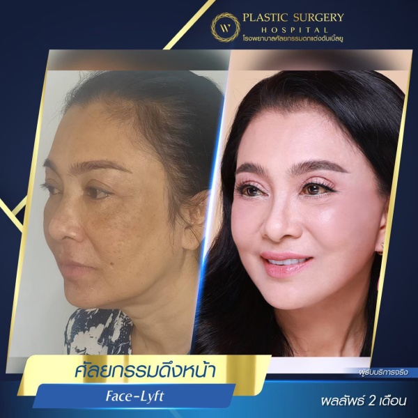 ดึงหน้า