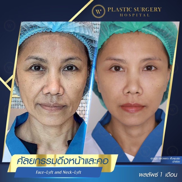 ดึงหน้า