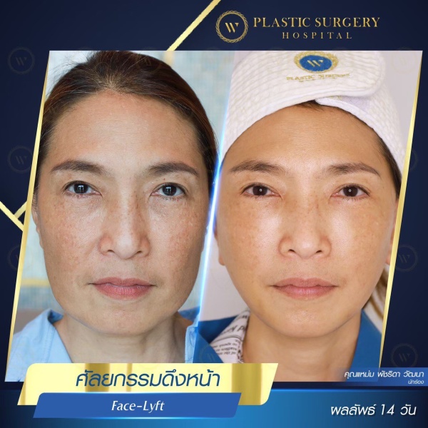 ดึงหน้า