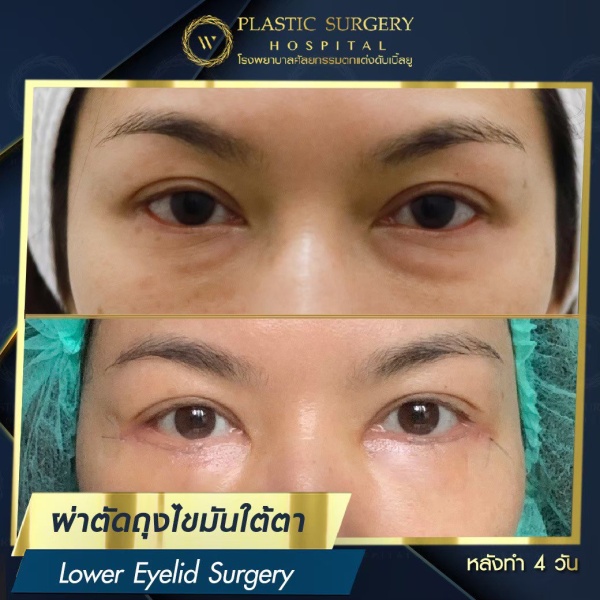ตัดถุงไขมันใต้ตา
