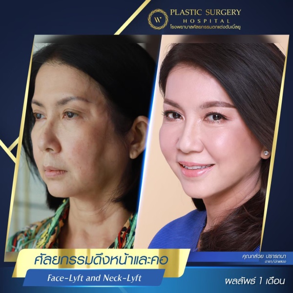 ดึงหน้า