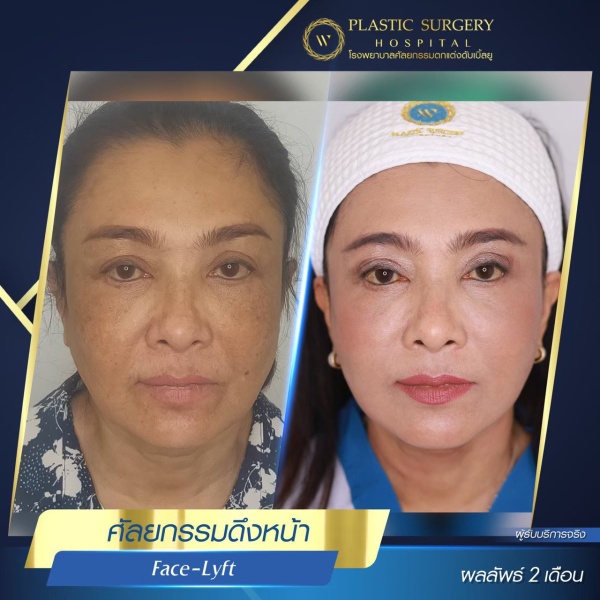 ดึงหน้า