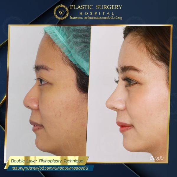 เสริมจมูก