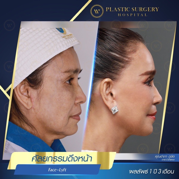 ดึงหน้า