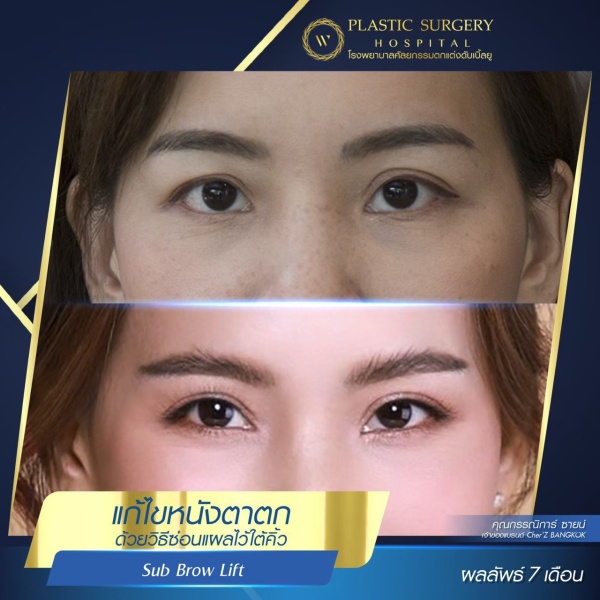 หนังตา/หางตาบนตก