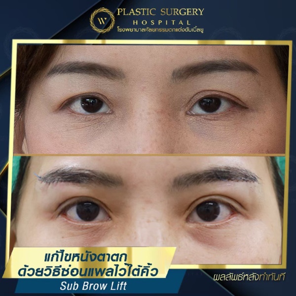 หนังตา/หางตาบนตก