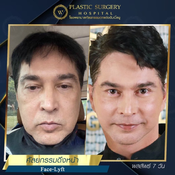 ดึงหน้า