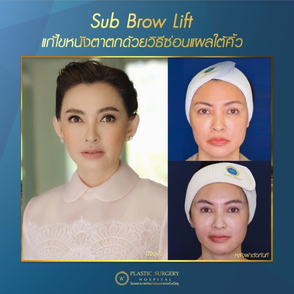 หนังตา/หางตาบนตก