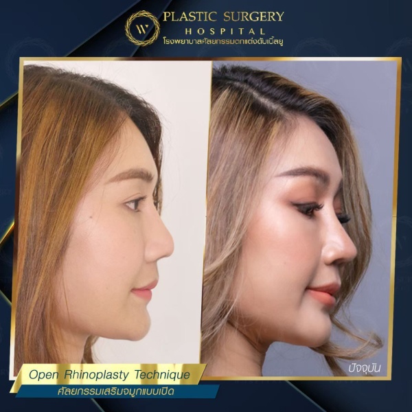 เสริมจมูก