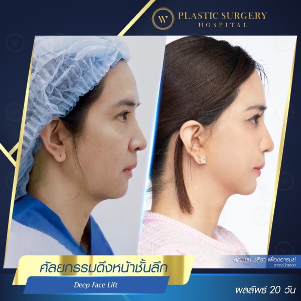 ดึงหน้า