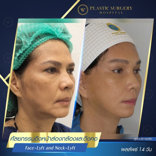 ดึงหน้า