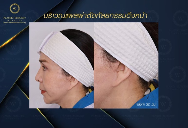 ดึงหน้า