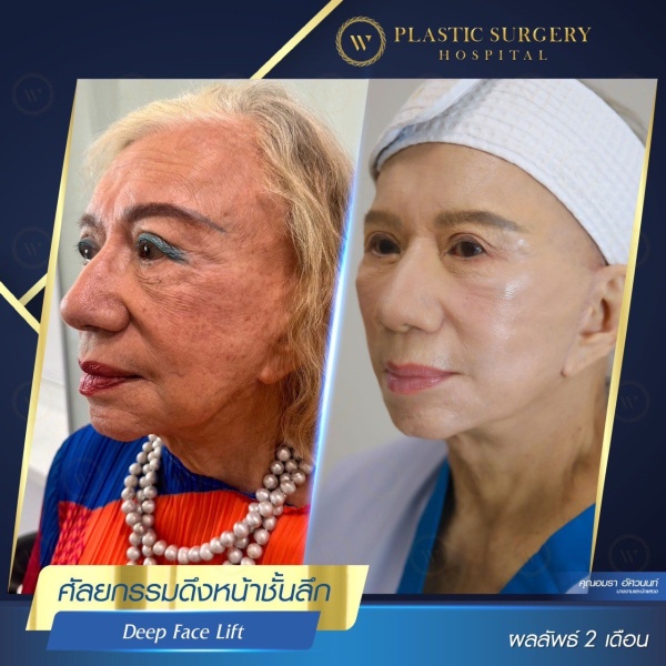 ดึงหน้า