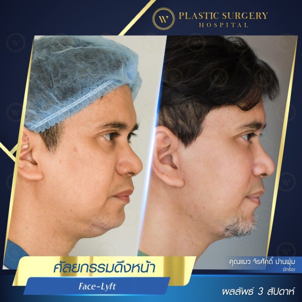 ดึงหน้า