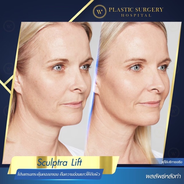 Sculptra Lift