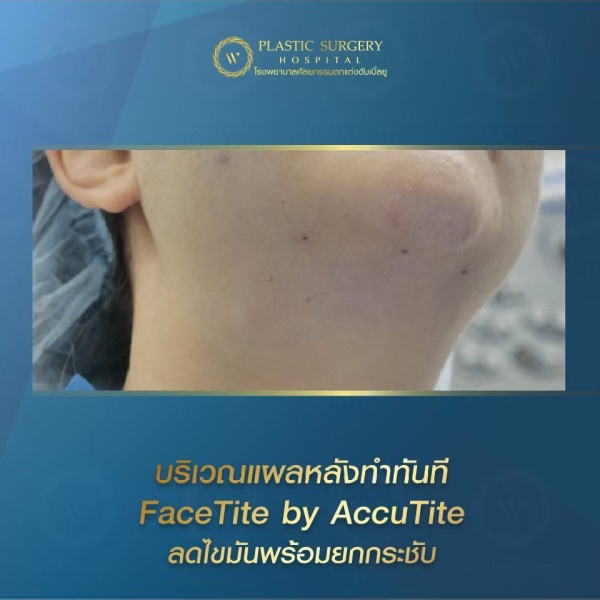 ดูดไขมันเหนียงใต้คาง (FaceTite)