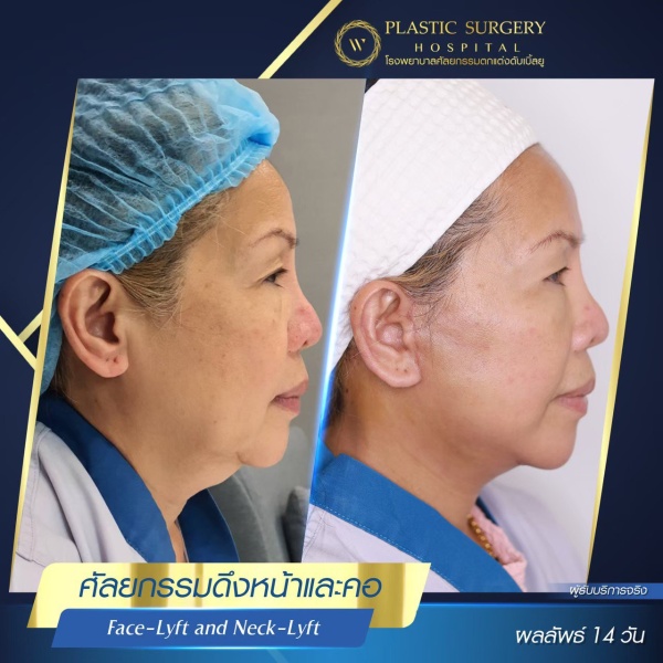 ดึงหน้า