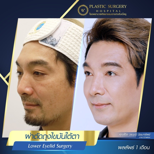 Lower Eyelid Surgery