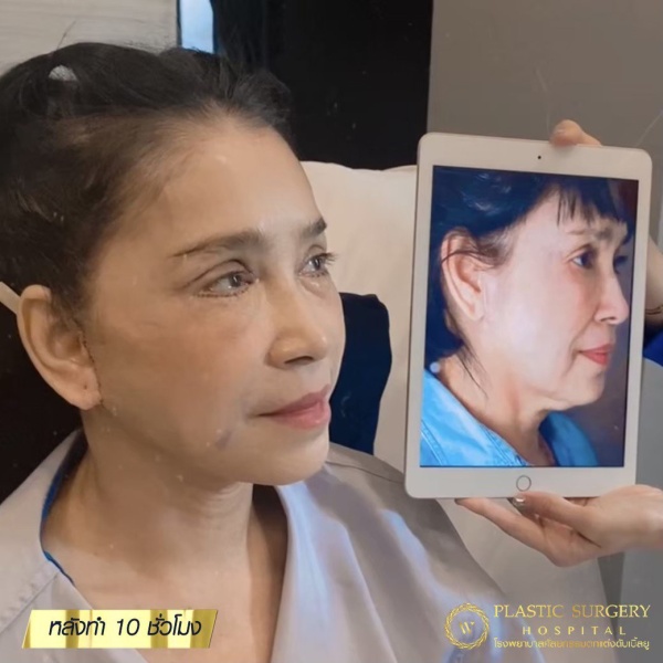 ดึงหน้า